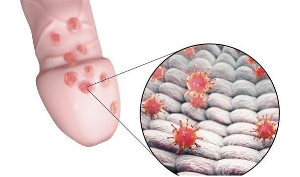 zakila handitzeko gelari alergia